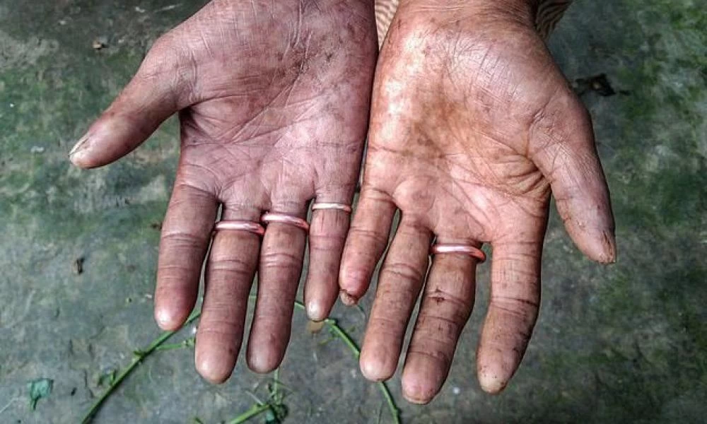 Απίστευτο: Τα μέλη οικογένειας που δεν έχει κανένας τους δαχτυλικά αποτυπώματα